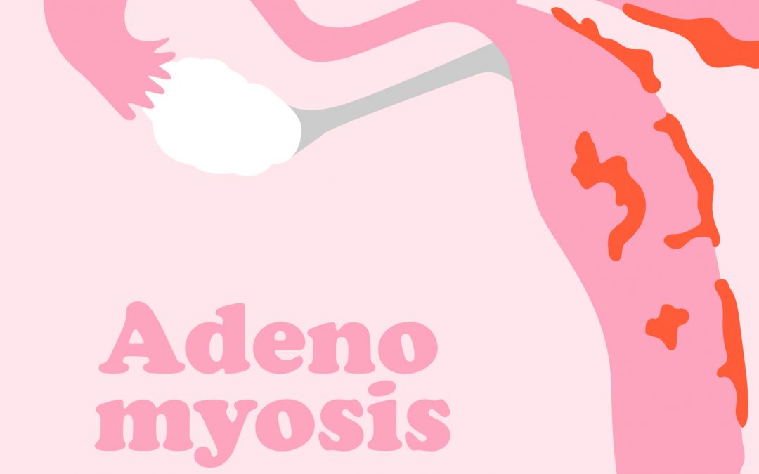 Adenomyosis & The Function Of Your Uterus