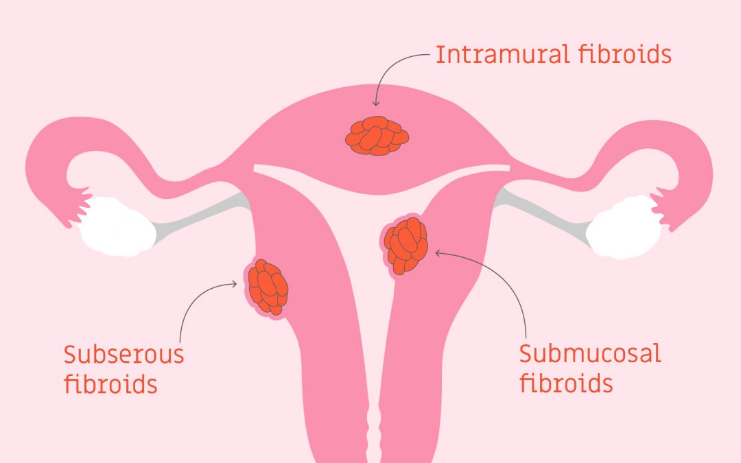 What Are Fibroids?
