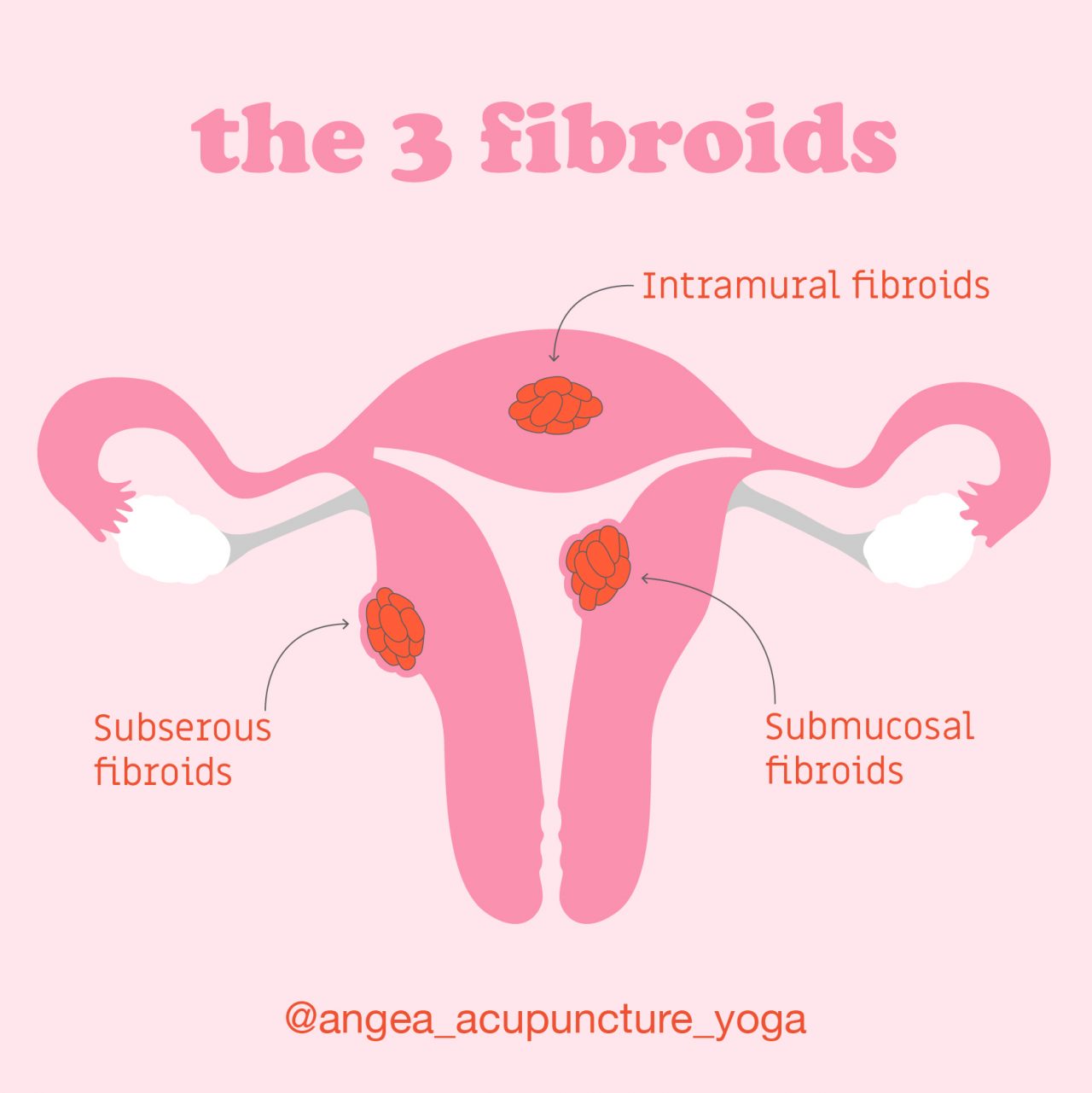 Intramural Fibroid Size Chart