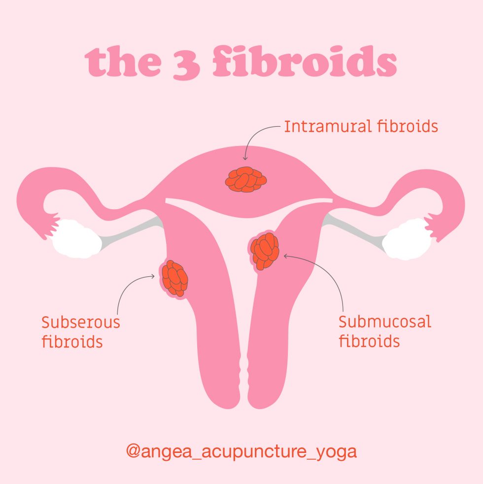 What Are Fibroids? - Angea