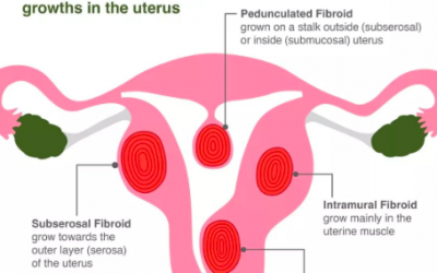 What Exactly Are Fibroids?