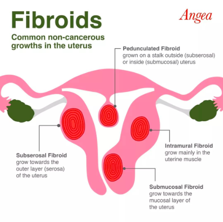 What Exactly Are Fibroids?